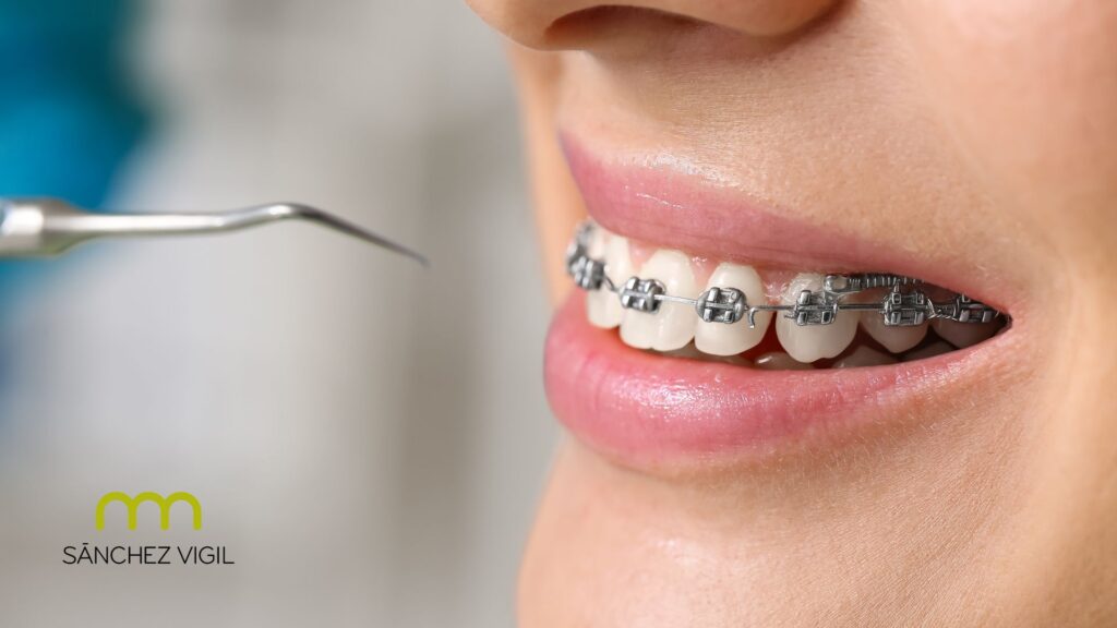 brakets metálicos